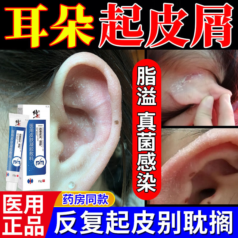 耳朵起皮屑脂溢性皮炎真菌感染外耳道廓湿疹干燥脱皮药房同款膏TU