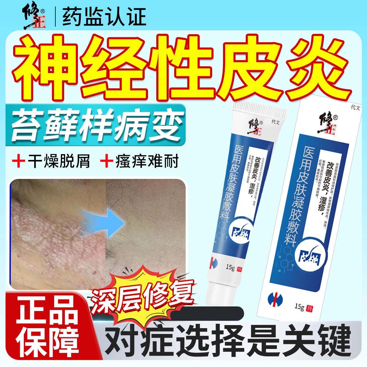 代文医用皮肤凝胶敷料神经性皮炎