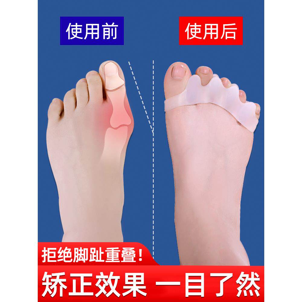 医用硅胶拇指外翻矫正器男女士大母食指分离小脚趾内翻弯曲分趾器