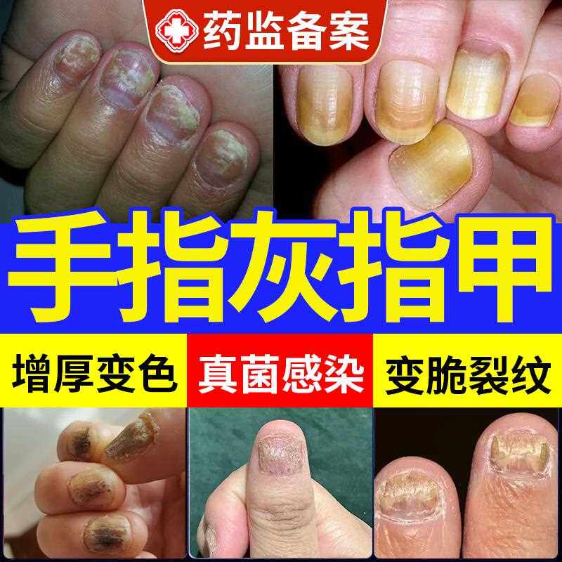 手指甲真菌感染灰指甲药房同款水癣专用白醋冰醋酸30抗菌一滴净jw