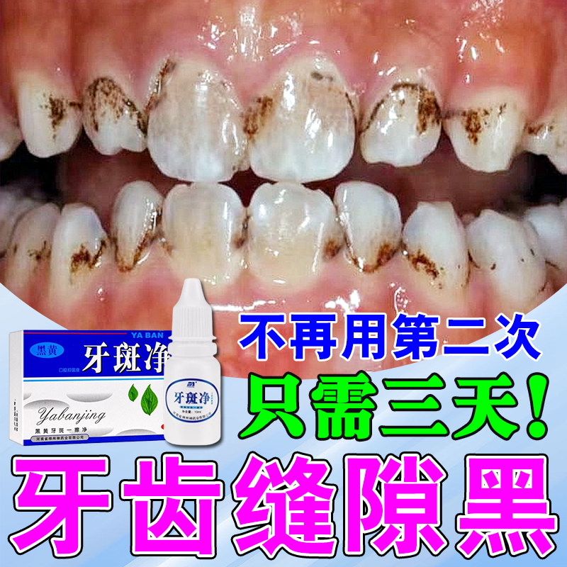 牙齿缝隙黑去牙缝发黑变黑牙齿去黑线黑渍牙窝沟专用清洁蛀牙菌斑