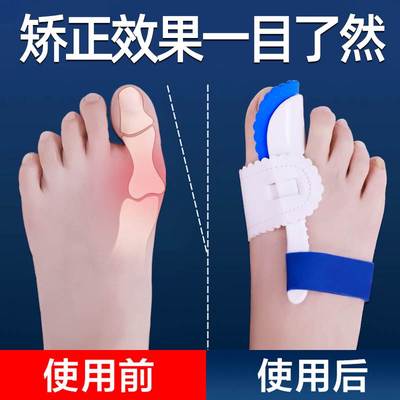 医用大母脚趾矫正器男女士严重重度弯曲拇指外翻神器大脚骨分趾器