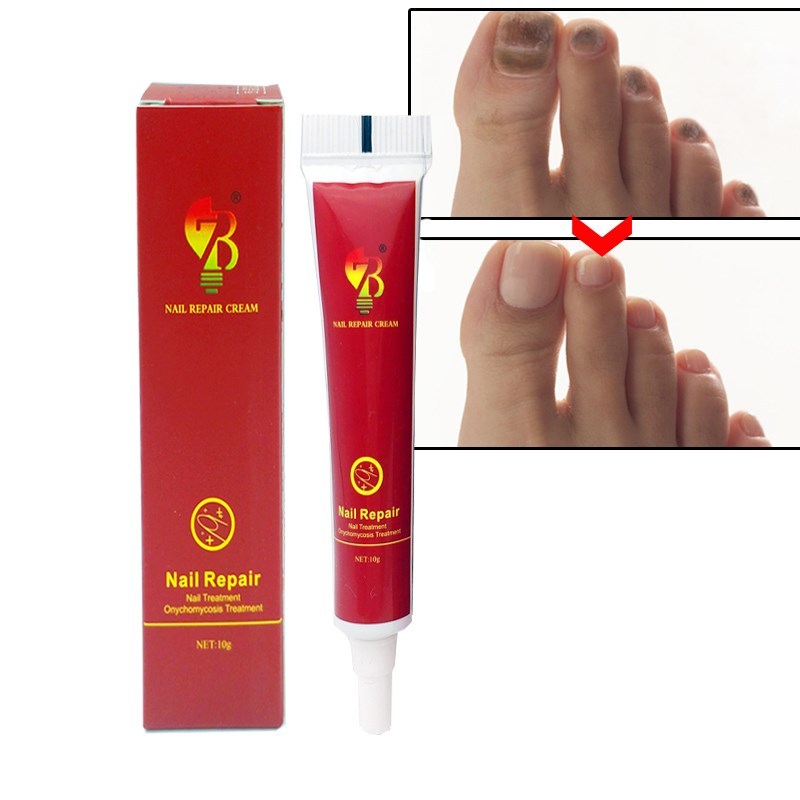 Best Fungus Nail Treatment Cream Onychomycosis Paronychia A