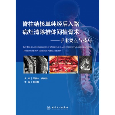 脊柱结核单纯经后入路病灶清除与椎体间植骨术——手术要点与