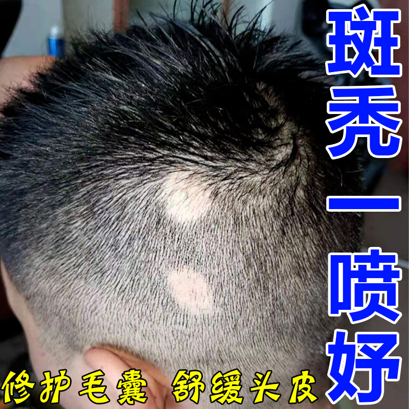 鬼剃头斑秃喷剂儿童斑秃防发成块掉发增发密发育发斑秃神器
