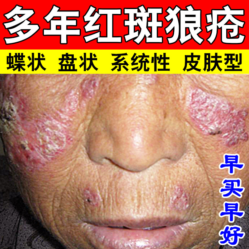 系统性狼疮面部亚急性皮肤型蝶状盘状疮膏