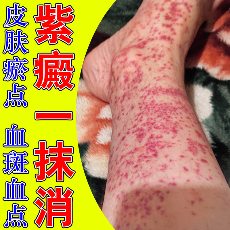 紫癜老年色素沉积四肢皮下出血瘀点血点紫癜