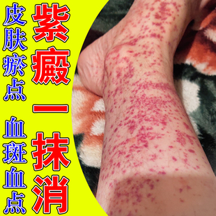 紫癜老年色素沉积四肢皮下出血瘀点血点紫癜