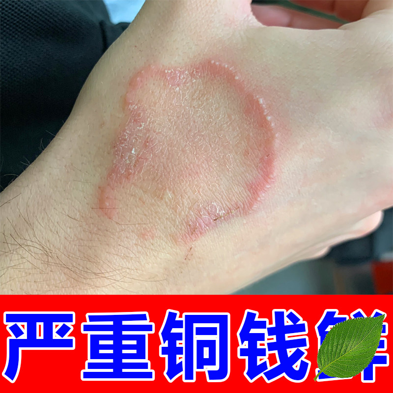 体鲜专用去铜钱鲜膏皮肤外用猫鲜人用
