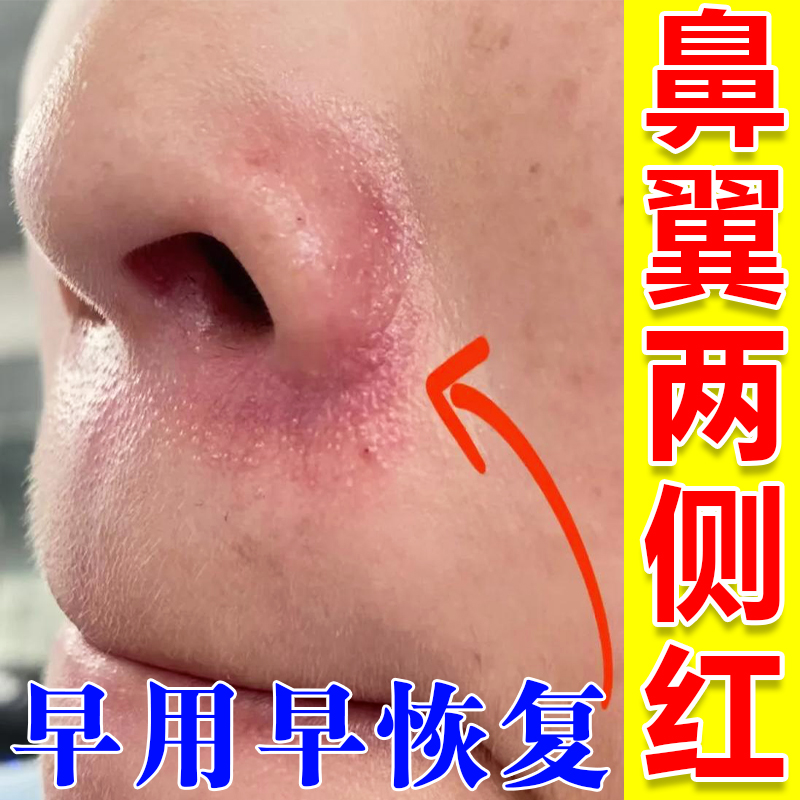 鼻子两侧发红脱皮鼻翼两边泛红干燥起皮掉皮酒糟鼻去鼻子泛红外用