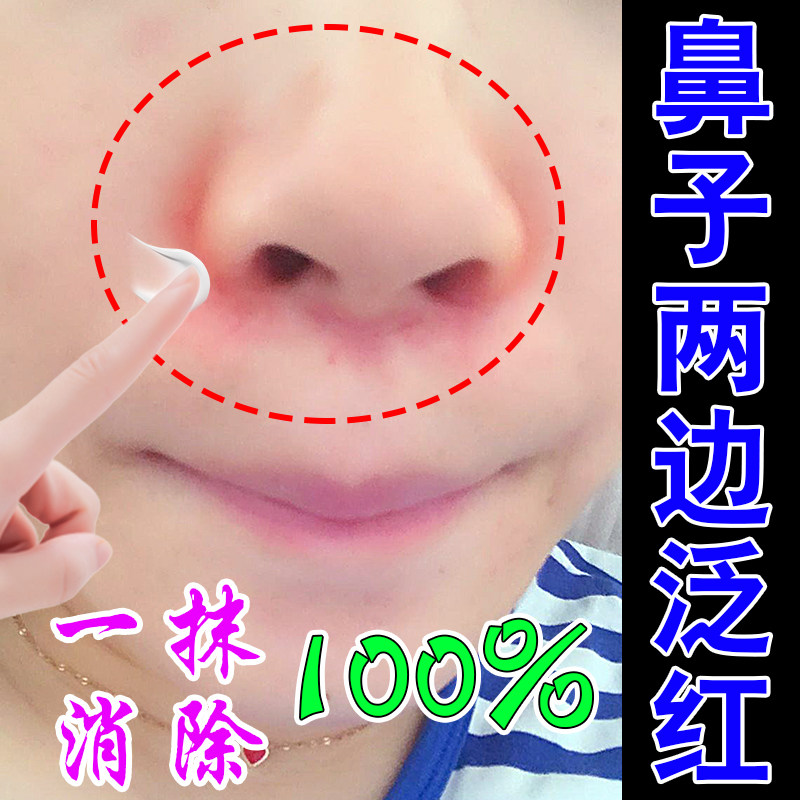 鼻子两边泛红鼻翼两侧发红干燥起皮草本乳膏