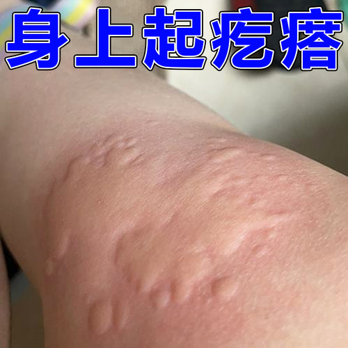 全身皮肤刺挠痒起红点季节性冶腿上长疙瘩痒软膏