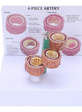 Atherosclerosis Thrombosis Model Vascular Disease Demonstrat