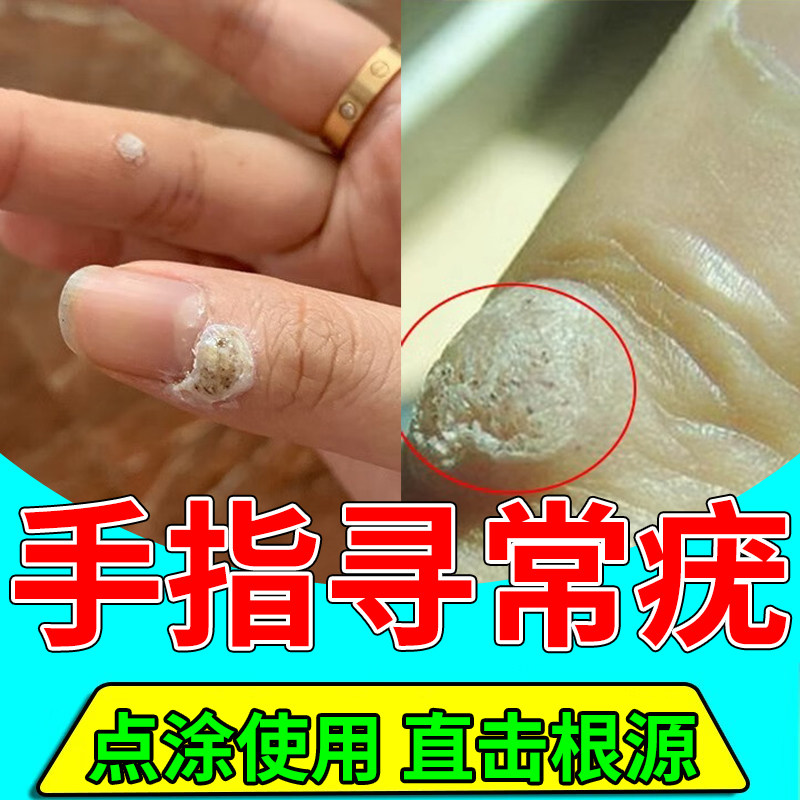 手指寻常疣猴子去刺猴肉刺小肉粒疙瘩除手上长猴子可配搭膏药贴cj