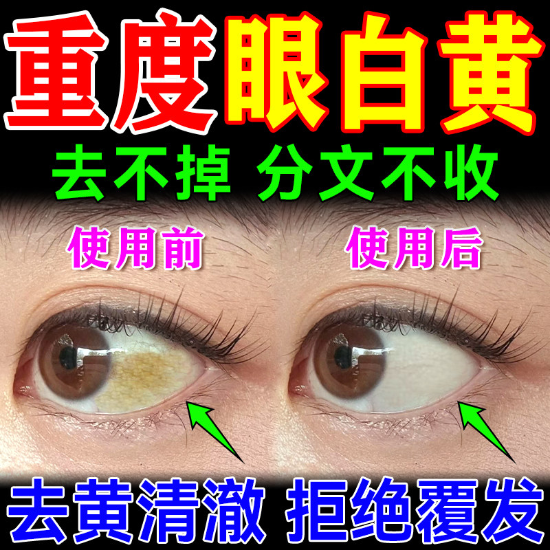 眼白发黄眼睛清澈去黄红血丝眼浑浊眼药水眼底黄斑修复病变滴眼液