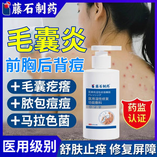 后背上长痘痘马色马拉色菌毛囊炎专用除螨祛痘痒沐浴露药房同款YZ