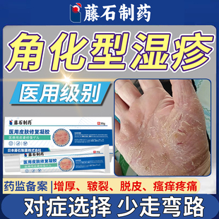 角化型湿疹手癣膏脱皮干裂瘙痒真菌感染手部手指角质化去手足癣WQ