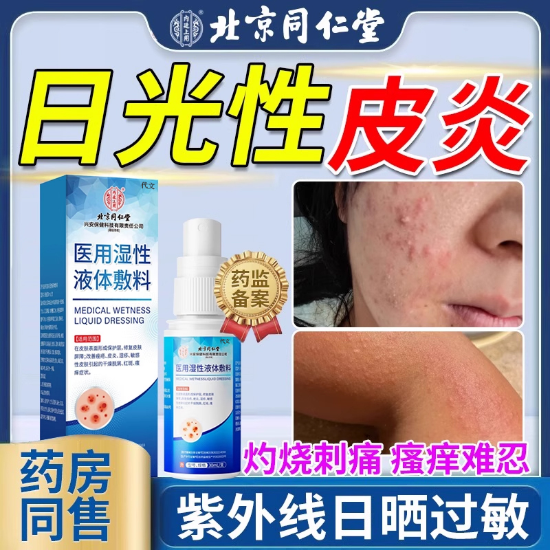 日光性皮炎紫外线过敏晒伤瘙痒
