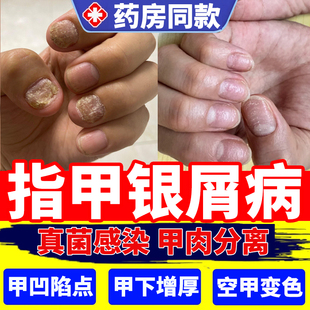 银屑病甲牛皮癣亮甲灰指甲专用真菌感染真菌性白甲凹陷药房同售DS