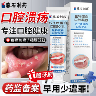 反复口腔溃疡凝胶专用舌头嘴巴口疮缓解液药房同售可搭牙膏用HT