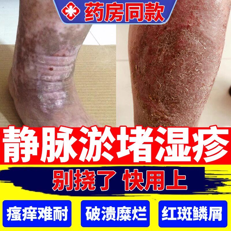 静脉曲张皮肤小腿瘙痒静脉炎淤积性皮炎湿疹发黑溃烂药房同售YZ