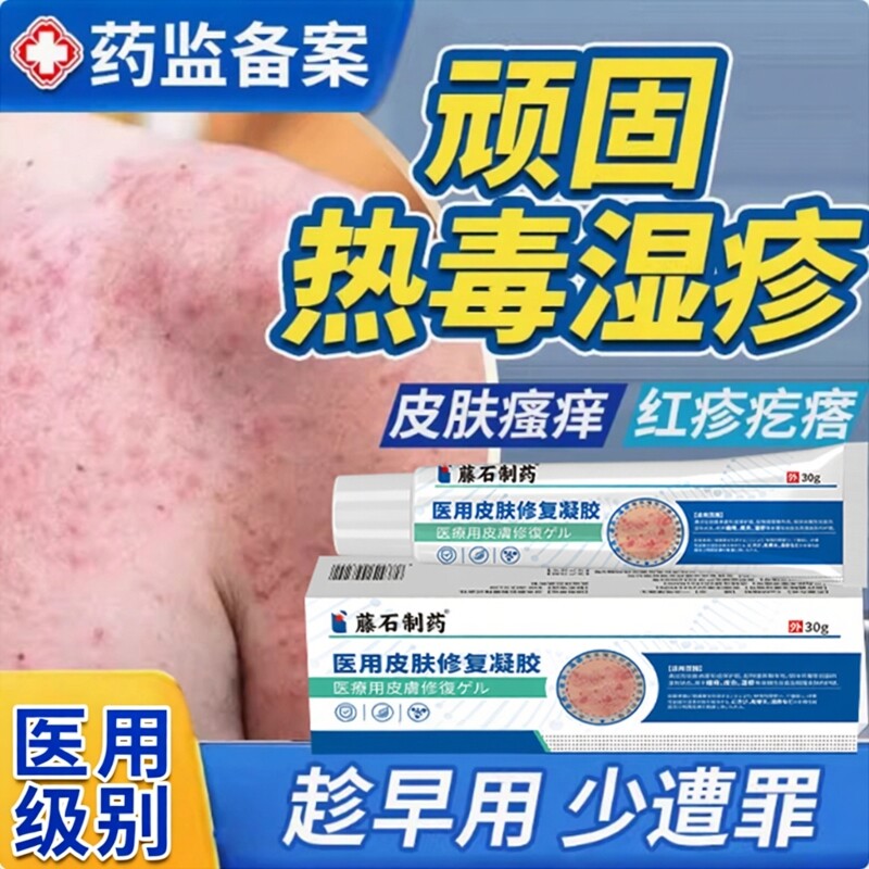 热毒湿疹止痒膏热疹血热型湿毒清软膏祛水泡顽固皮炎湿痒根真菌DS
