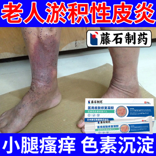 老年人淤积性皮炎小腿湿疹皮肤瘙痒增厚溃疡黑色素沉淀去止痒根WQ