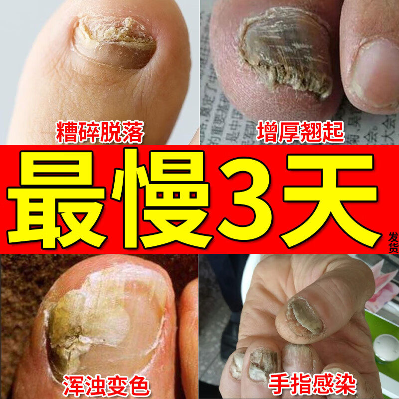 灰指甲药去真菌感染脚气官方旗舰店正品抑菌专用药液软膏手脚甲癣