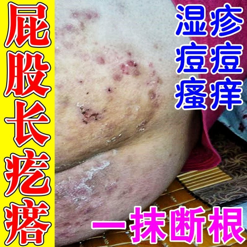 屁股上长痘痘痒起热疙瘩藓治大人屁股沟瘙痒久坐坐板疮股癣拔毒膏