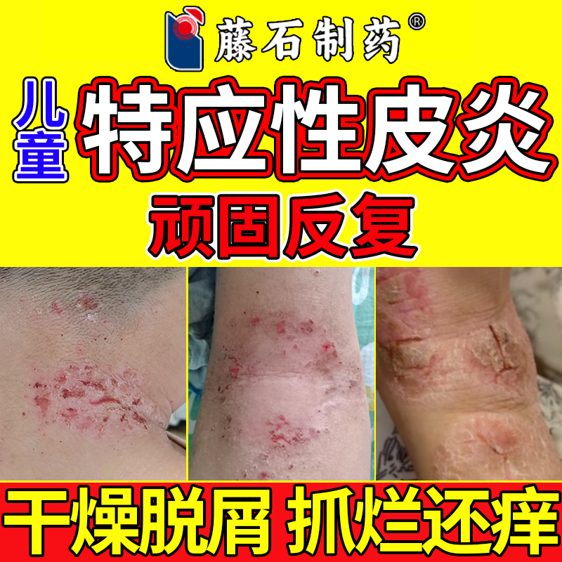 儿童特应性皮炎皮肤瘙痒敷料止痒去搭保湿霜身体乳湿疹外用膏QK