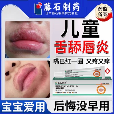 儿童唇炎口唇炎专用唇膏烂嘴巴