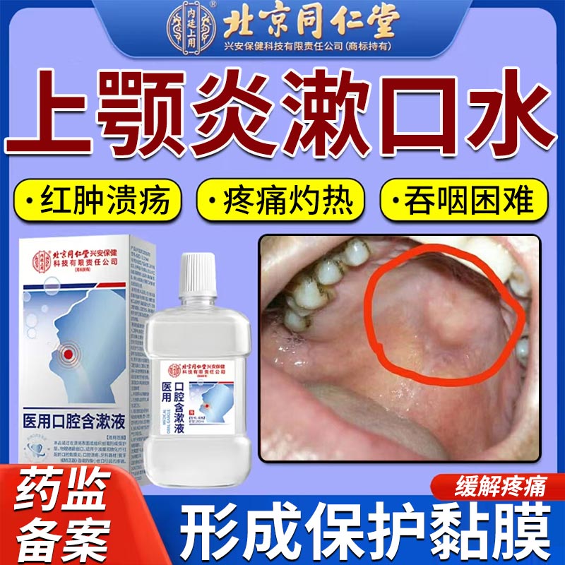 上颚炎漱口水口腔上颚红肿疼痛溃疡灼热起泡真菌感染喷剂医用级js