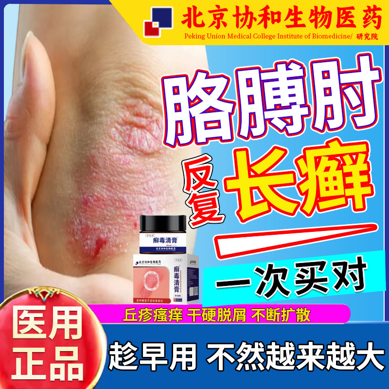 手肘癣胳膊肘癣止痒去角质起皮脱皮js神经性皮炎去除外用膏根