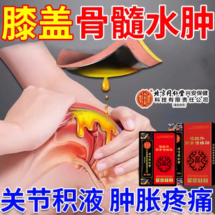 骨髓水肿专用膏药贴崴脚踝膝盖韧带胫骨膜炎积水液肿胀关节疼痛CA