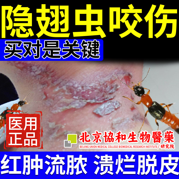 隐翅虫咬伤皮炎止痒药膏皮肤湿疹止痒去根外用顽固皮炎真菌感染js