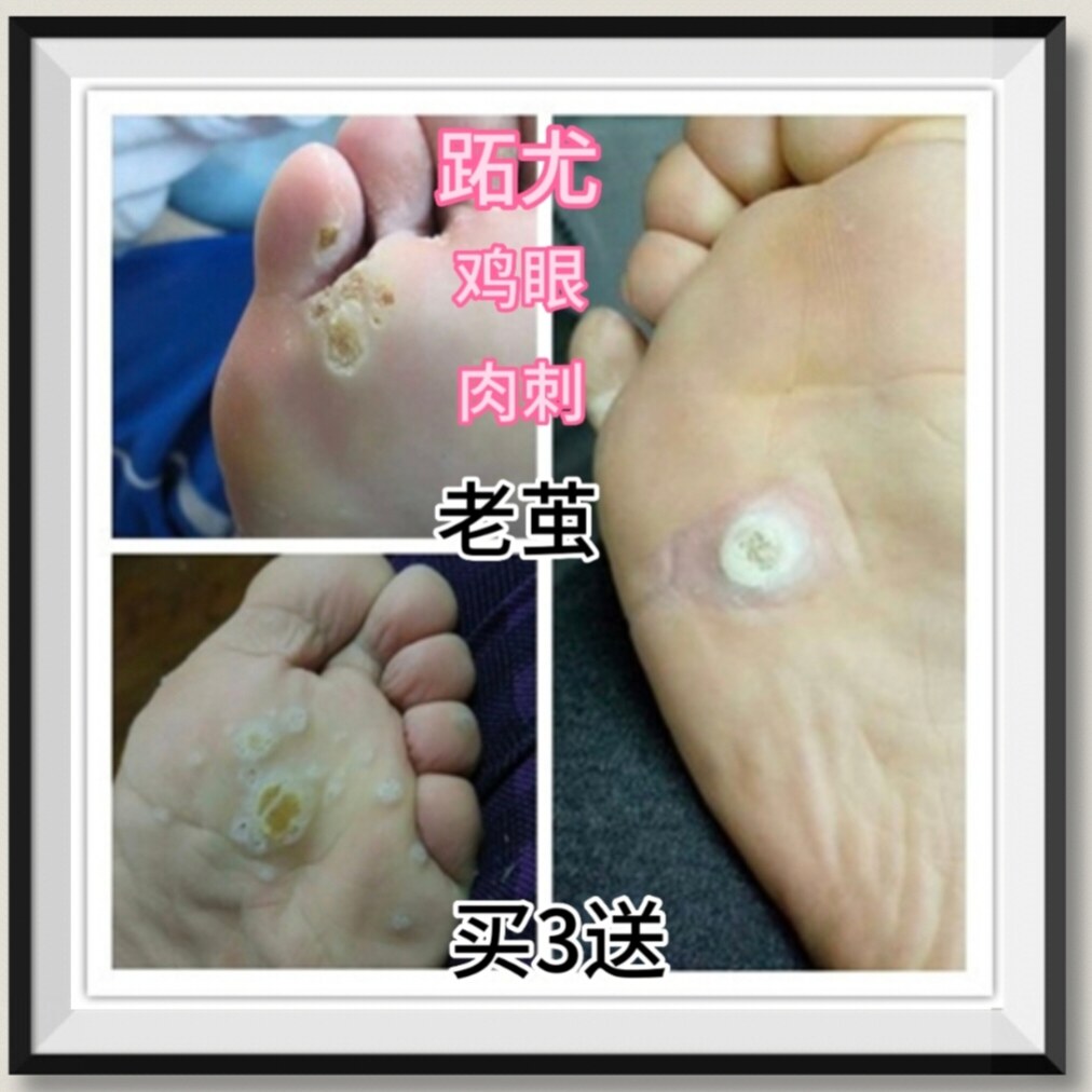 止尤液鸡眼跖尤丝状尤肉刺老茧血包刺买3盒送1买6盒送3盒送同款五