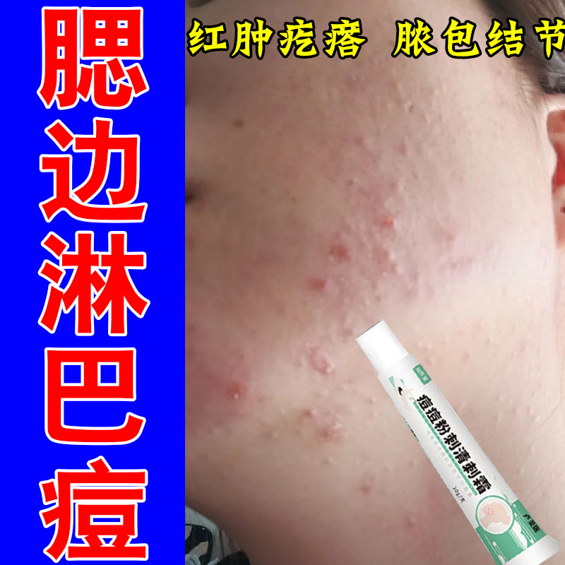 淋巴腮边反复舒缓脸颊侧红肿疙瘩脓包闭口粉刺疙瘩修护草本乳膏