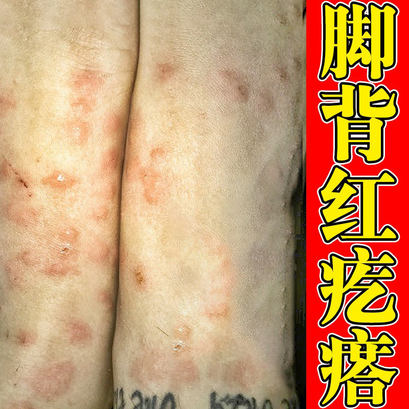 脚背夏天脚面起红疙瘩足脚背小红豆豆专用软膏,保健用品,皮肤消毒护理（消）,淘宝优惠券,粉丝福利购,淘宝优惠卷
