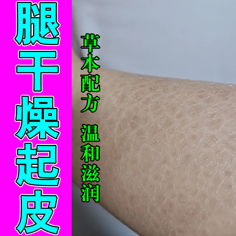 小腿皮肤干燥起皮掉皮屑身上起干皮鱼鳞皮肤粗糙裂纹保湿甘油