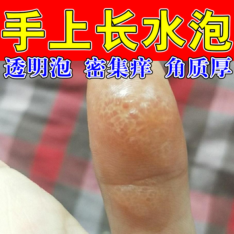 手指起透明疙瘩小水泡手脚出汗痒水泡密集透明疙瘩发痒颗粒修护膏