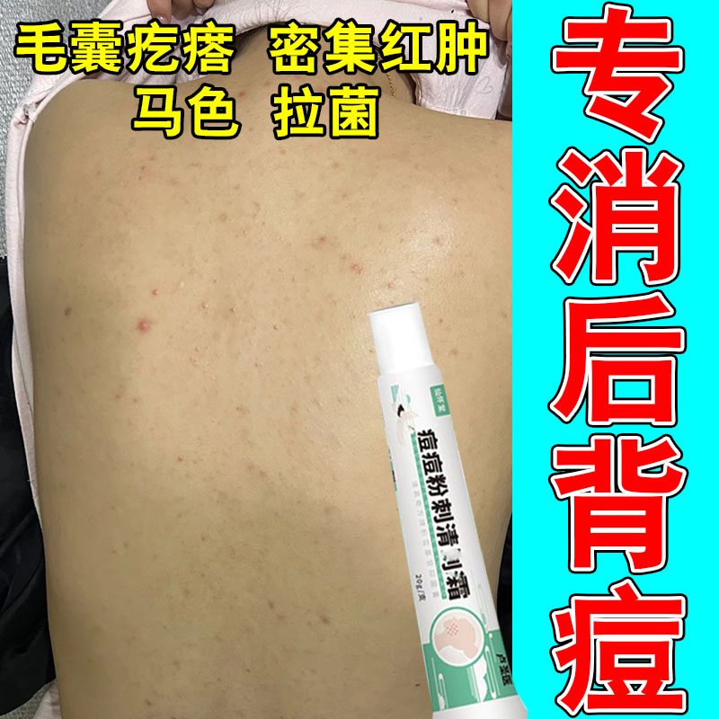 冶后背长痘胸口身体背上长有痘红硬发痒毛囊疙瘩密集草本修护膏