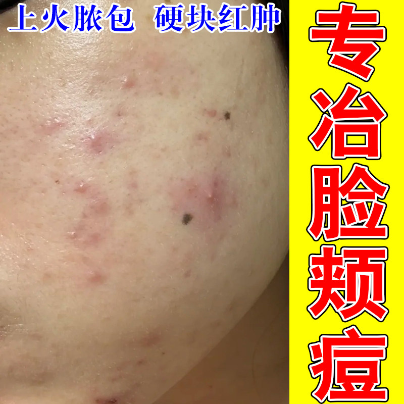 冶脸上痘红肿疙瘩硬起皮干燥痘成人粉刺疙瘩修护草本保湿乳霜
