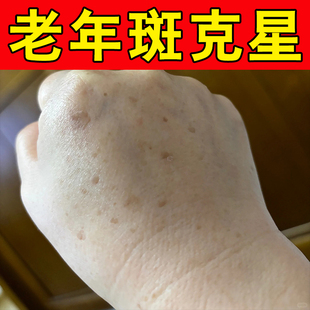手背老年斑手上脸部身上黄褐斑黑色素斑点黑斑膏日晒黑斑专用软膏