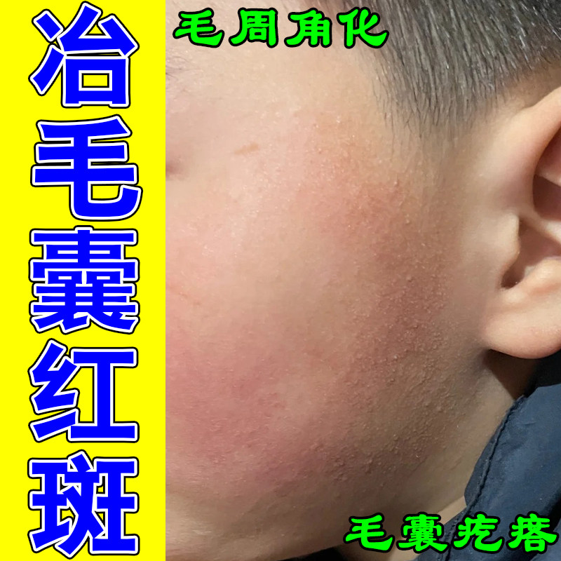 冶脸毛囊红斑黑变角质凸起疙瘩堆积暗沉脸部泛红黑粗糙草本修护膏