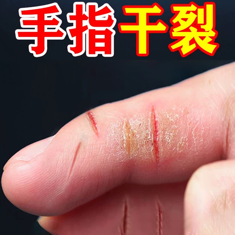 冶手裂的软膏手指头脚后跟干裂口子起硬皮足跟开裂修复专用软膏