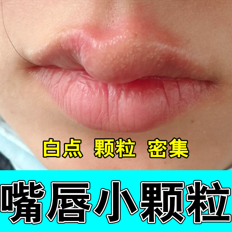 唇部凸起白点嘴唇脂肪小颗粒增生干燥起皮起泡修护植物萃取膏