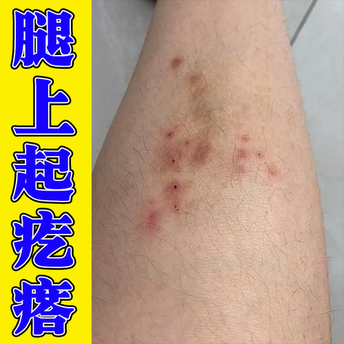 夏天天热小腿痒皮肤腿部干燥起皮腿上长小红点疙瘩全身起红疙瘩药