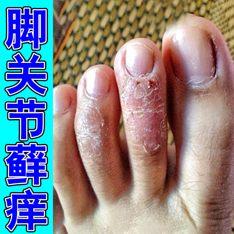 脚趾关节上长冶脚趾头痒脚背痒干燥起皮红斑刺挠真菌感染用软膏