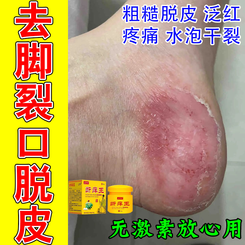 冶掌趾干裂掌跖角化型手掌起皮水泡干裂红斑干裂疼痛舒缓保湿膏
