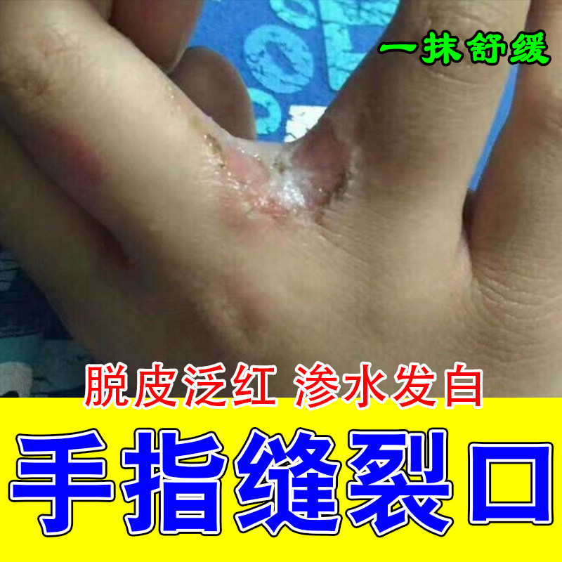 手指缝脱皮渗水发白经常碰水起皮手缝脱皮真菌水泡开裂发红修护膏